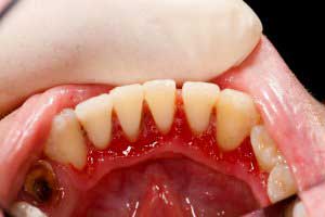What Is Dental Plaque - Bacterial Plaque, Tartar, Gingivitis, Gum Disease